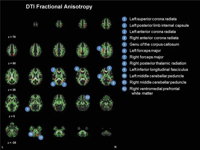 Cognitive Rehabilitation Therapy CRT