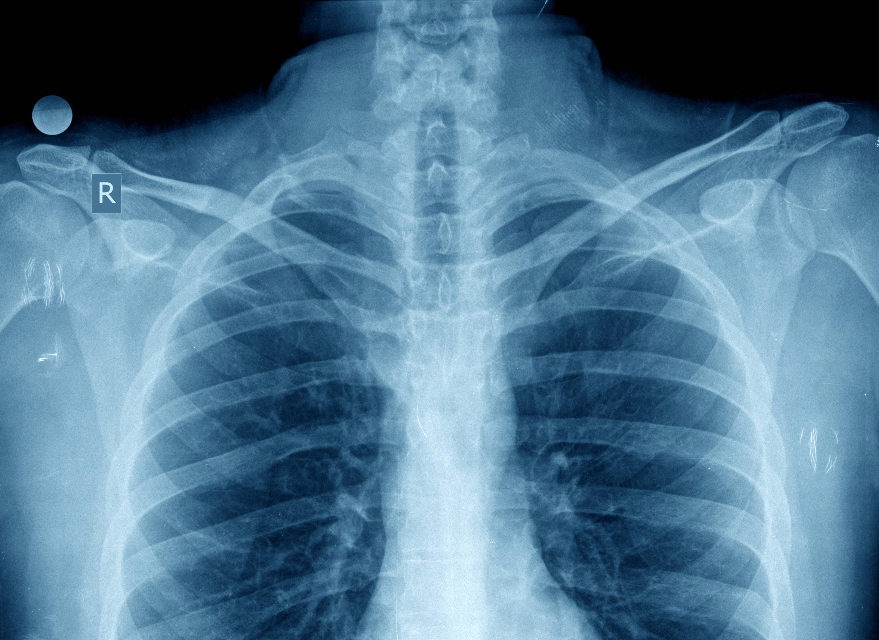 xray image of human lungs